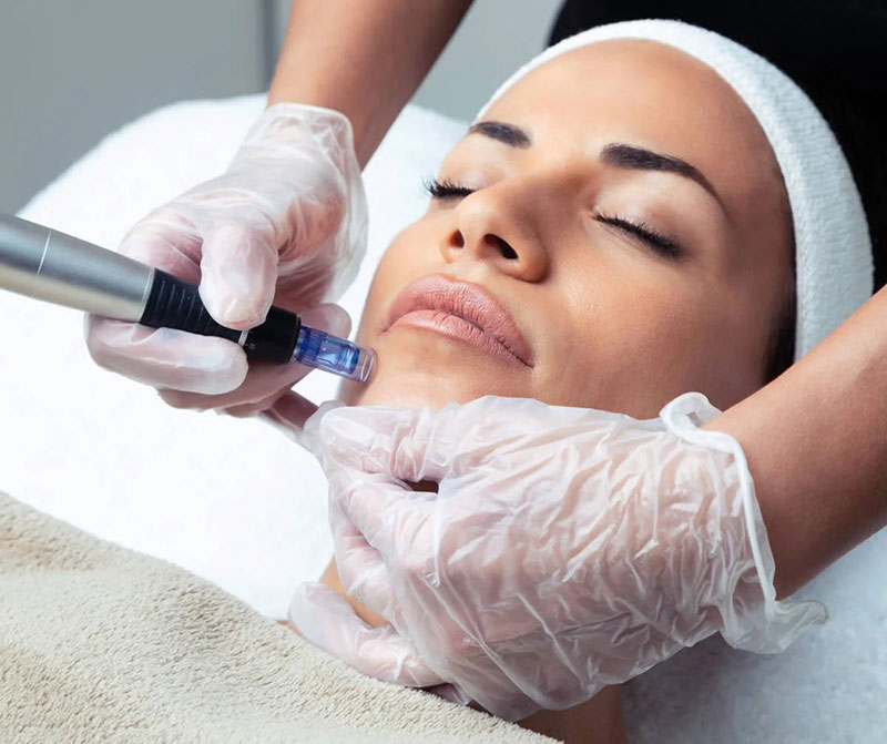 RF Microneedling